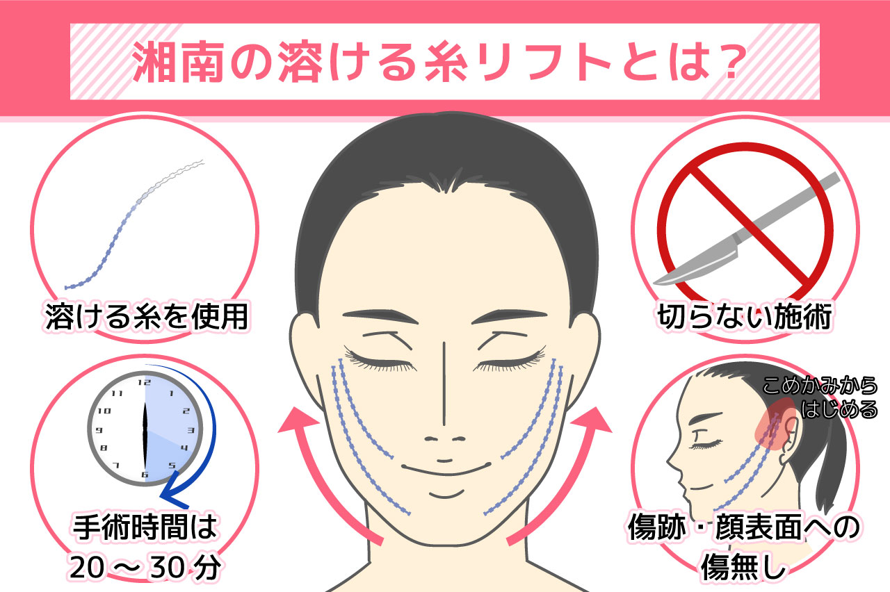 湘南の溶ける糸リフトとは